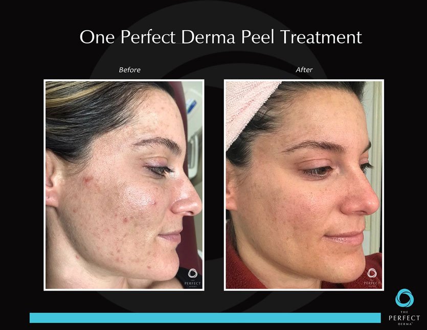 PerfectDerma